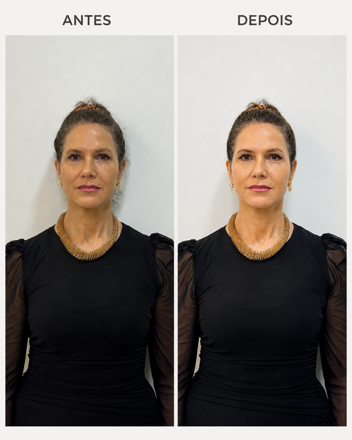 Resultado de antes e depois do tratamento iPRF Face